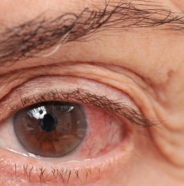 kalici-gorme-kaybinin-en-onemli-3.-nedeni!