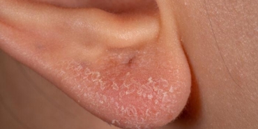 deri-hastaliklarini-tetikliyor