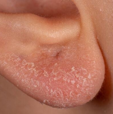 deri-hastaliklarini-tetikliyor