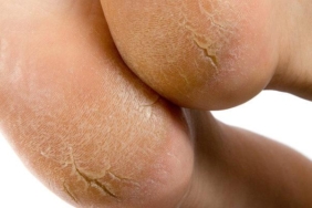 kurumus-ve-catlamis-topuklari-iyilestirmenin-dogal-yolu!-ilaci-evinizde:-kaynatip-surun