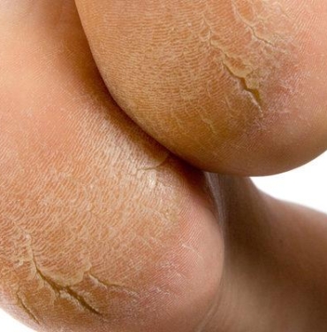 kurumus-ve-catlamis-topuklari-iyilestirmenin-dogal-yolu!-ilaci-evinizde:-kaynatip-surun