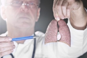 akciger-kanserine-yakalanma-riski-cok-yuksek