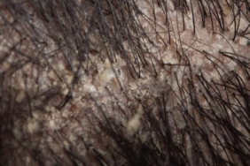 sac-yaglanmasina-cozum-bulmak-icin-cuvalla-para-harcamayin!-cozumu-evinizde