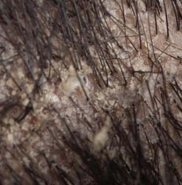 sac-yaglanmasina-cozum-bulmak-icin-cuvalla-para-harcamayin!-cozumu-evinizde