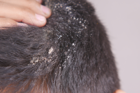 basit-sac-kepegi-diyerek-gecistirmeyin!-kafa-derisinde-gorulen-bu-durum-tehlikeli-hastaligin-ciddi-belirtisi