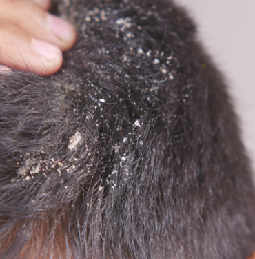 basit-sac-kepegi-diyerek-gecistirmeyin!-kafa-derisinde-gorulen-bu-durum-tehlikeli-hastaligin-ciddi-belirtisi