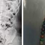 karnindan-cikartilan-boncuklar-saymakla-bitmedi!-bagirsaklari-parcalanmis…