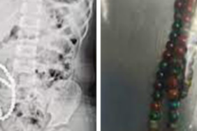 karnindan-cikartilan-boncuklar-saymakla-bitmedi!-bagirsaklari-parcalanmis…