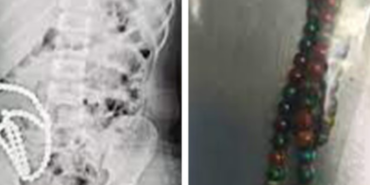 karnindan-cikartilan-boncuklar-saymakla-bitmedi!-bagirsaklari-parcalanmis…