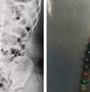 karnindan-cikartilan-boncuklar-saymakla-bitmedi!-bagirsaklari-parcalanmis…