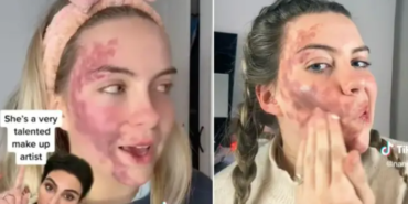 tiktok’ta-hastaligini-paylasti!-dermatolog-tarafindan-sahtekarlikla-suclandi