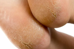 catlamis-topuklari-aninda-pamuk-gibi-yapacak!-catlamis-topuklardan-kurtulmak-icin-dogal-cozumler