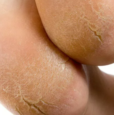 catlamis-topuklari-aninda-pamuk-gibi-yapacak!-catlamis-topuklardan-kurtulmak-icin-dogal-cozumler