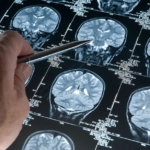 japonya’da,-alzheimer-belirtilerini-saptayabilen-kan-testi-kiti-onaylandi