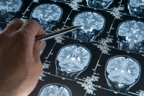 japonya’da,-alzheimer-belirtilerini-saptayabilen-kan-testi-kiti-onaylandi