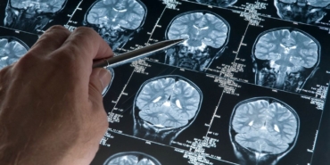 japonya’da,-alzheimer-belirtilerini-saptayabilen-kan-testi-kiti-onaylandi