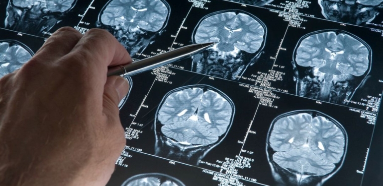 Japonya’da, Alzheimer belirtilerini saptayabilen kan testi kiti onaylandı