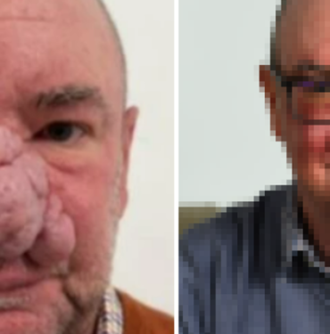 her-sey-ufak-kirisiklikla-baslamisti!-‘fil-adam’-gibi-hisseden-adam-ameliyattan-sonraki-goruntusunu-paylasti