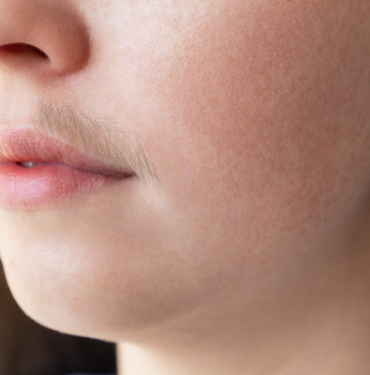 her-sey-vucudunda-cikan-tuylerle-basladi!-onemsiz-goruluyor-ama-kanserin-belirtisi-olabilir