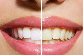 dis-hekimlerinin-kimseye-soylemedigi-sirri!-disleri-inci-gibi-bembeyaz-yapacak