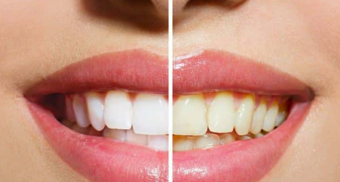 dis-hekimlerinin-kimseye-soylemedigi-sirri!-disleri-inci-gibi-bembeyaz-yapacak