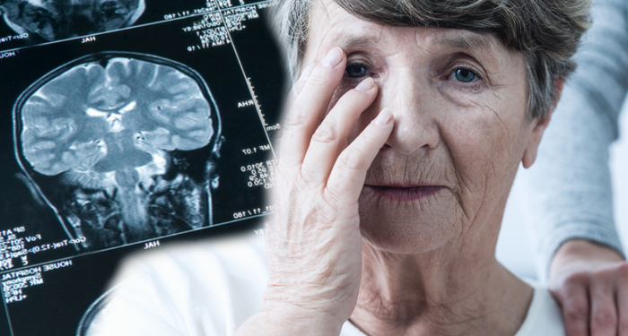 Her şey önceden hissediliyormuş! Alzheimer’ın en erken belirtilerine dikkat