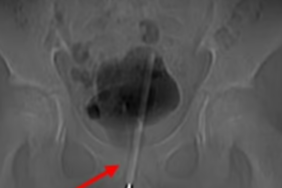 cinsel-zevk-icin-canindan-oluyordu!-mesanesinden-cikani-gorenler-gozlerine inanamadi