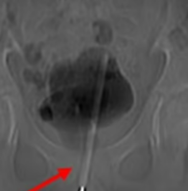 cinsel-zevk-icin-canindan-oluyordu!-mesanesinden-cikani-gorenler-gozlerine inanamadi