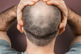 direkt-lavaboya-dokun!-sadece-bir-bardagi-bile-kel-kalmaniza-neden-olabilir