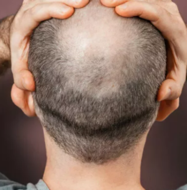 direkt-lavaboya-dokun!-sadece-bir-bardagi-bile-kel-kalmaniza-neden-olabilir