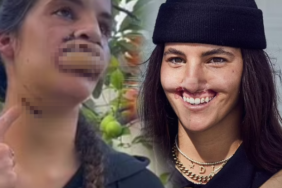 pitbull-saldirisi-nedeniyle-gulusunu-kaybetti!-dehset-anlarini-teker-teker-anlatti