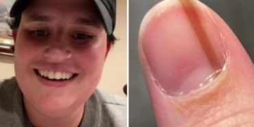 tirnak-cizgisinin-havali-oldugunu-dusundu!-gercekleri-ogrenince-hayatinin-sokunu-yasadi:-olumcul-hastaligin-belirtisi