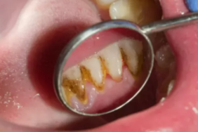 cozumu-kolay!-dis-tartarini-ve-taslarini-temizlemenin-en-etkili-yolu