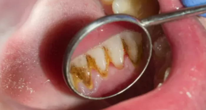 cozumu-kolay!-dis-tartarini-ve-taslarini-temizlemenin-en-etkili-yolu