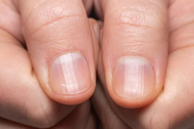 sakin-onemsiz-gormeyin:-tirnaginizda-gorulen-ufak-degisikliklere-dikkat!-tumor-habercisi-olabilir