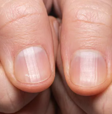 sakin-onemsiz-gormeyin:-tirnaginizda-gorulen-ufak-degisikliklere-dikkat!-tumor-habercisi-olabilir