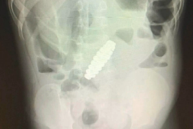 siddetli-karin-agrisinin-nedeni-herkesi-sok-etti!-yanlis-teshis-nedeniyle-apandisti-alindi-ama-gercekler-bambaskaydi…