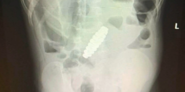 siddetli-karin-agrisinin-nedeni-herkesi-sok-etti!-yanlis-teshis-nedeniyle-apandisti-alindi-ama-gercekler-bambaskaydi…