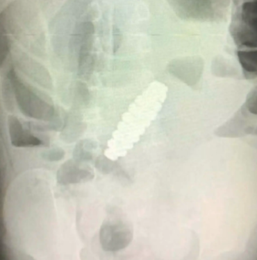 siddetli-karin-agrisinin-nedeni-herkesi-sok-etti!-yanlis-teshis-nedeniyle-apandisti-alindi-ama-gercekler-bambaskaydi…