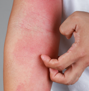 dikkat!-turkiye’de-sayi-giderek-artiyor…-belirti-gostermeden-hizlica-bulasiyor!