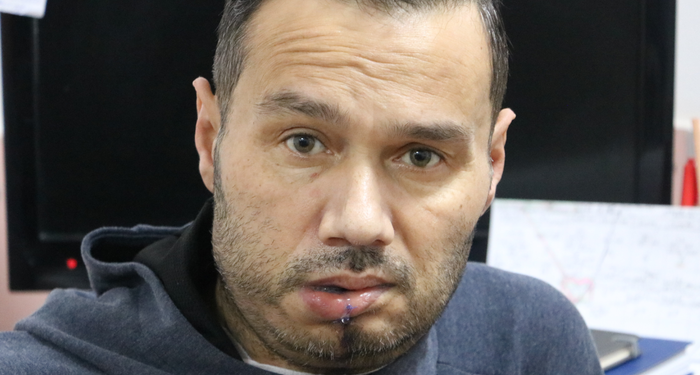 her-sey-agzinda-gecmeyen-ufak-bir-yarayla-basladi!-cenesi-kesilerek-kaval-kemiginden-parca-takildi