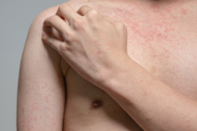 giderek-artan-kizamik-vakalari-endise-yaratti!-olumcul-salgin-yeniden-baslayabilir