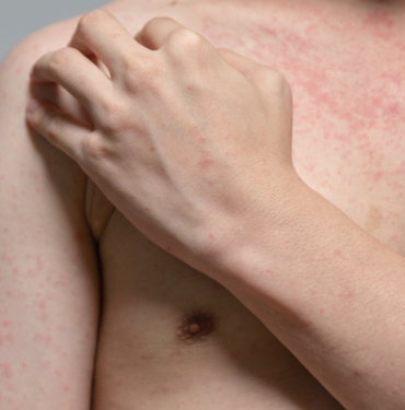 giderek-artan-kizamik-vakalari-endise-yaratti!-olumcul-salgin-yeniden-baslayabilir