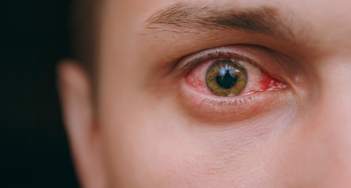 uzmanlardan-onemli-uyari!-giderek-yayilan-salgin-antibiyotige-karsi-duyarli