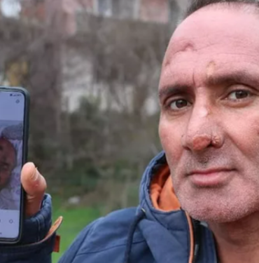 sinek-isirigiyla-hayatinin-kabusunu-yasadi!-yuzu-taninamayacak-hale-geldi