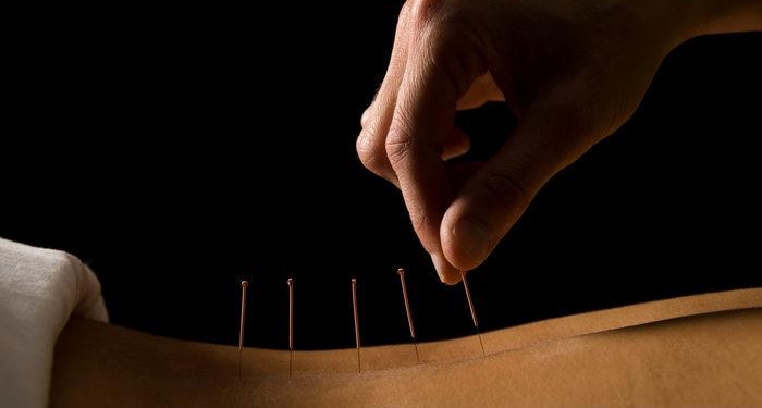 Cinsel sağlık için akupunktur nasıl kullanılır, cinsel tedavi nasıl yapılır? Akupunktur cinsel sağlığa iyi gelir mi, cinsel akupunktur noktaları nelerdir?