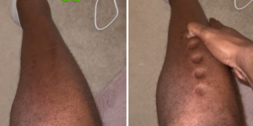 sessiz-katil’in-onemli-belirtisi!-vucudu-oyun-hamuruna-donen-adam-yasadiklarini-paylasti