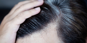 genetik-diyerek-gecistirmeyin!-sac-beyazlamasi-ciddi-hastaligin-belirtisi-olabilir