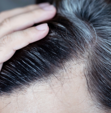 genetik-diyerek-gecistirmeyin!-sac-beyazlamasi-ciddi-hastaligin-belirtisi-olabilir