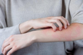 egzamaya-ne-iyi-gelir,-nasil-gecer?-egzamaya-iyi-gelen-dogal-yontemler-nedir,-bitkisel-tedavi-onerileri